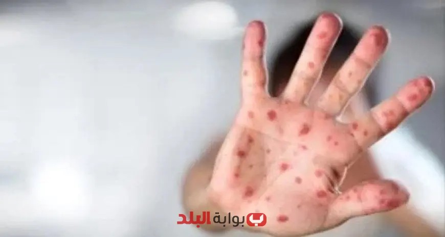غينيا تُسجّل 18 حالة إصابة جديدة بفيروس جدري القردة: تزايد القلق حول انتشار الوباء