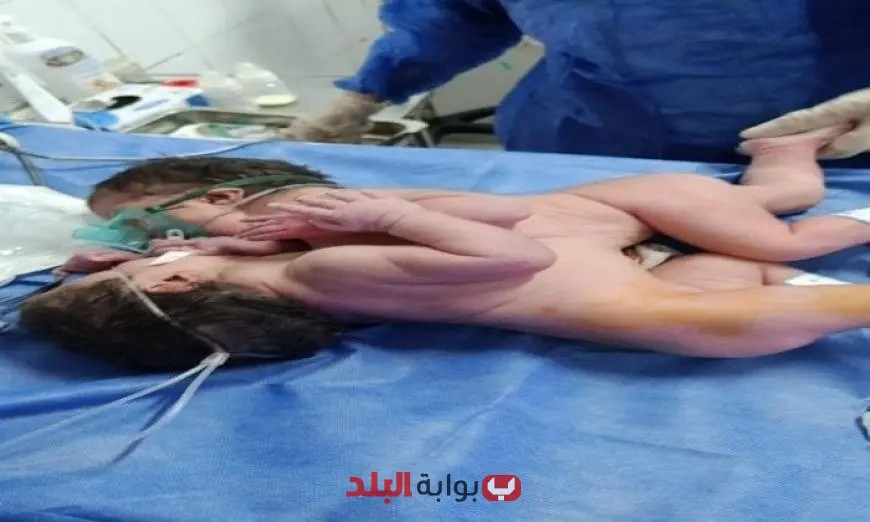 ولادة نادرة لتوأم ملتصق في مستشفى الفيوم العام: حدث طبي يُلهم الجميع