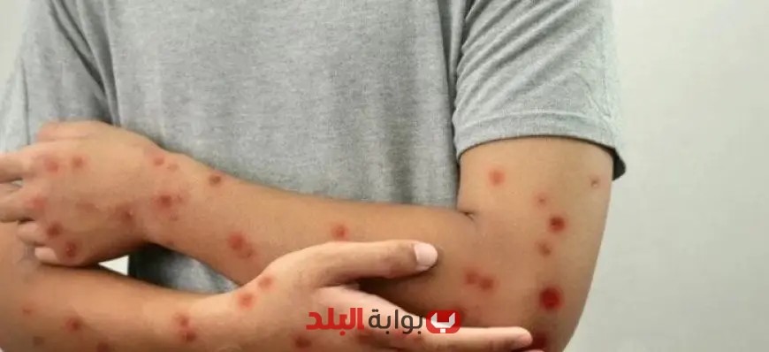 غينيا تُسجّل 206 إصابات جديدة بفيروس جدري القرود: ما الذي يعنيه ذلك للصحة العامة؟