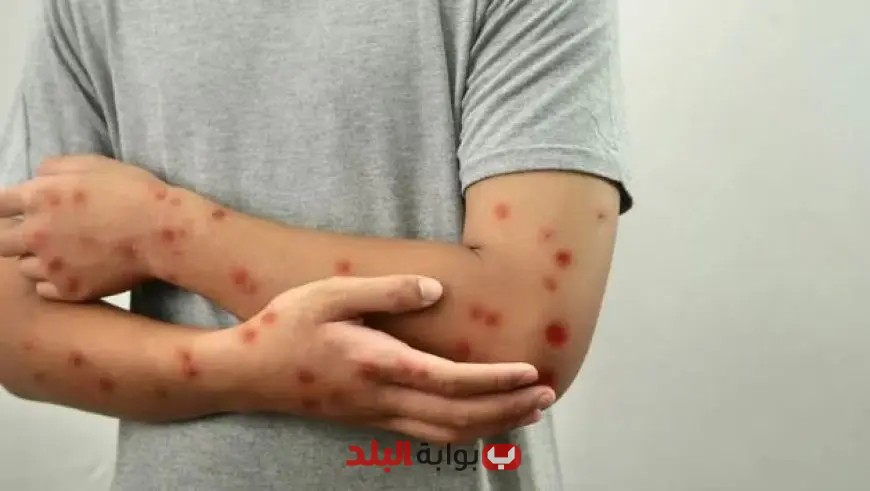 غينيا تسجل أكثر من 300 حالة إصابة مؤكدة بجدري القرود في إطار حالة الطوارئ الصحية العامة