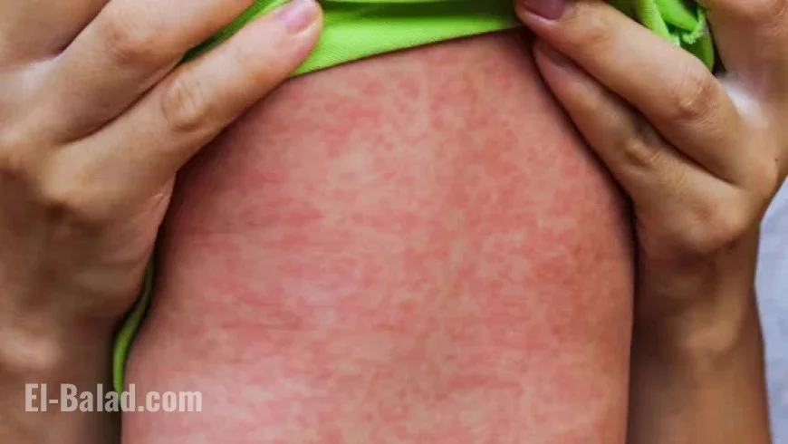 Measles Outbreak in Alberta Claims Life of Premature Infant